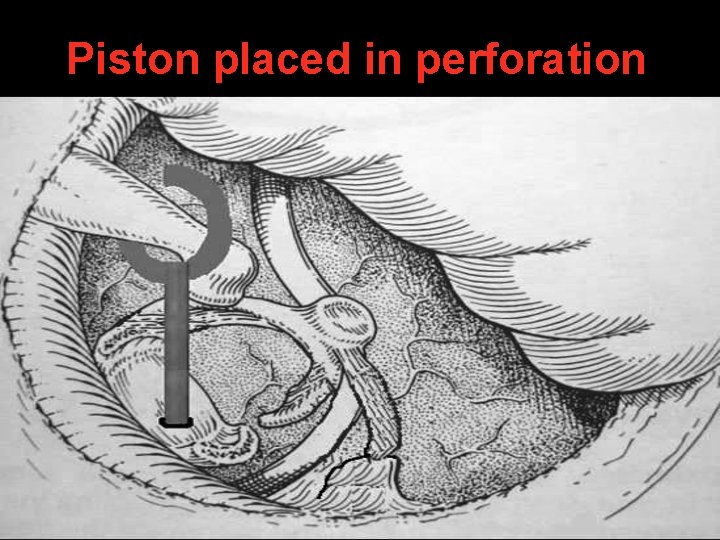 Piston placed in perforation Piston placed in perforation