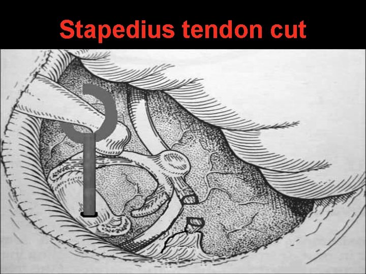 Stapedius tendon cut Stapedius tendon cut
