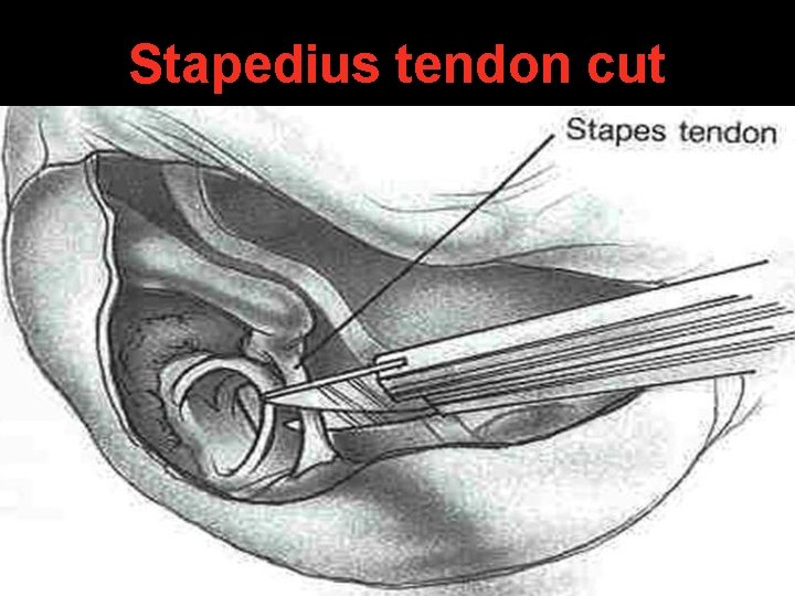 Stapedius tendon cut Stapedius tendon cut