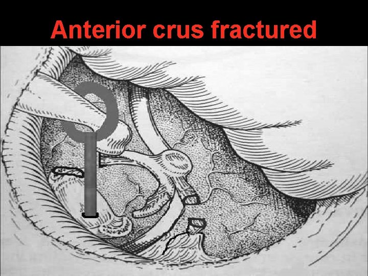 Anterior crus fractured Anterior crus fractured