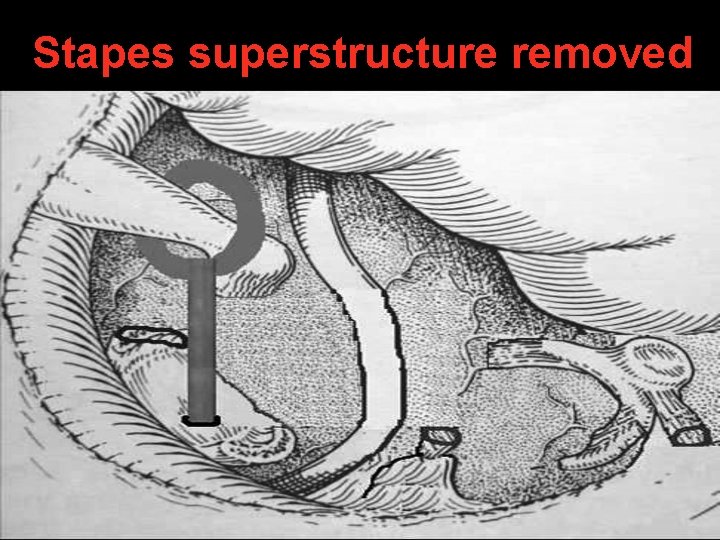 Stapes superstructure removed Stapes superstructure removed