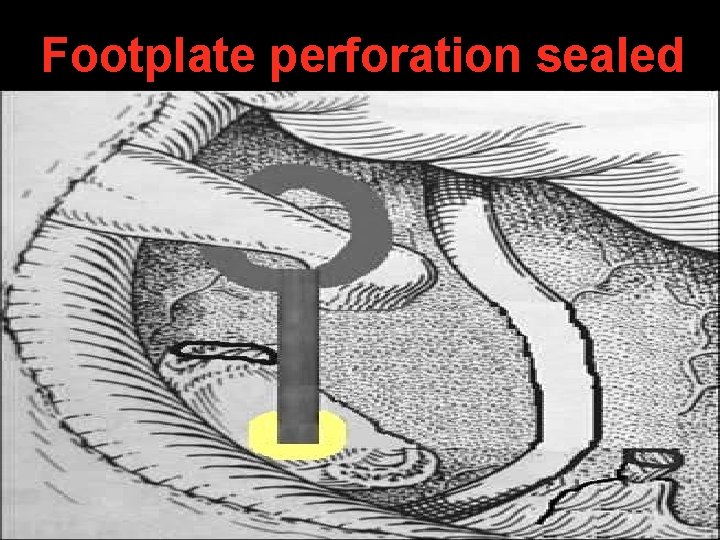Footplate perforation sealed Footplate perforation sealed
