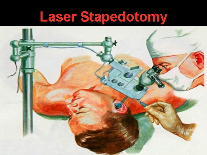 Laser Stapedotomy Laser Stapedotomy