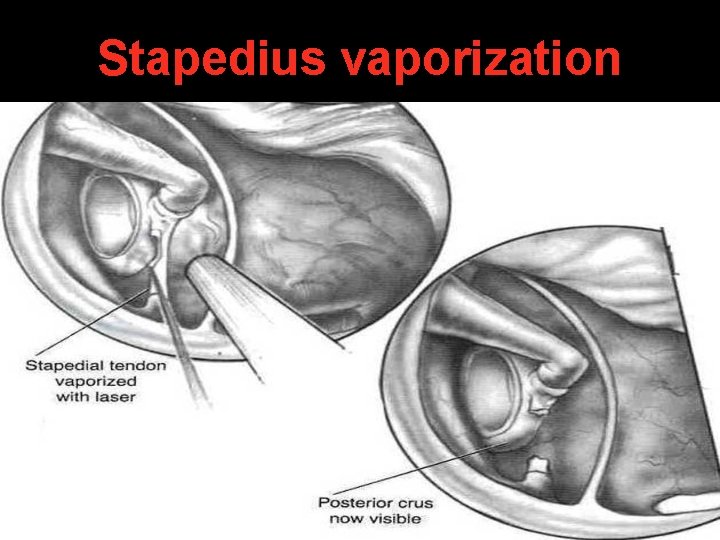 Stapedius vaporization Stapedius vaporization