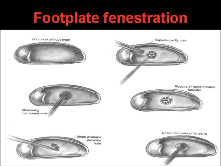 Footplate fenestration Footplate fenestration