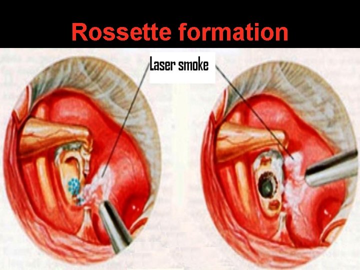 Rossette formation Rossette formation