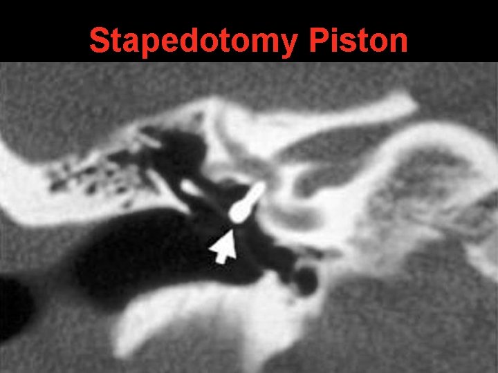 Stapedotomy Piston Stapedotomy Piston