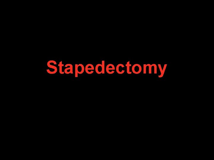 Stapedectomy Stapedectomy