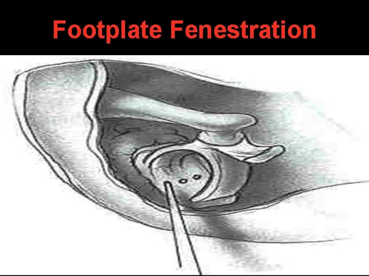 Footplate Fenestration Footplate Fenestration