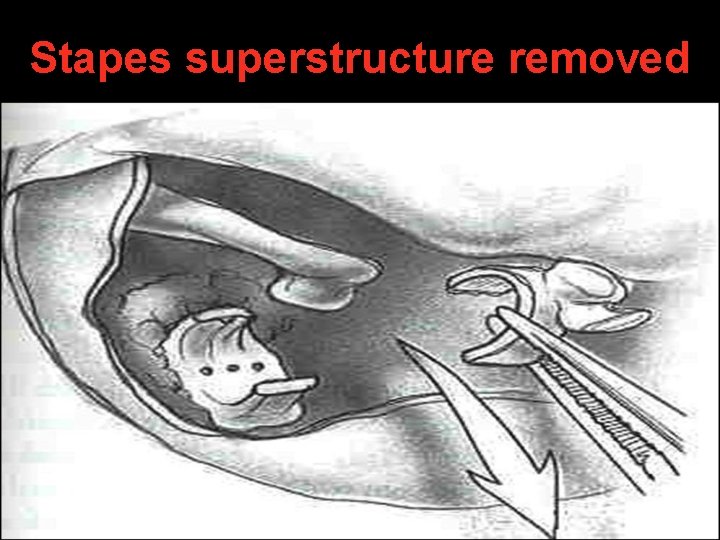 Stapes superstructure removed Stapes superstructure removed