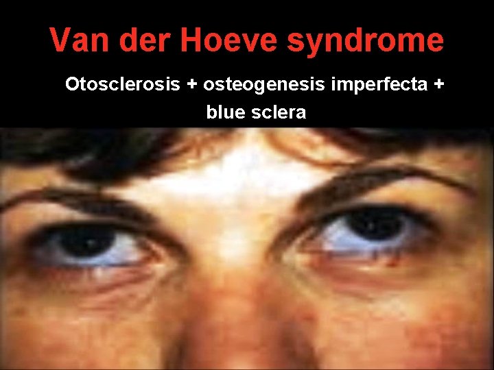 Van der Hoeve syndrome Otosclerosis + osteogenesis imperfecta + blue sclera Van der Hoeve syndrome Otosclerosis + osteogenesis imperfecta + blue sclera