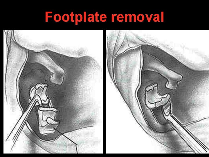 Footplate removal Footplate removal