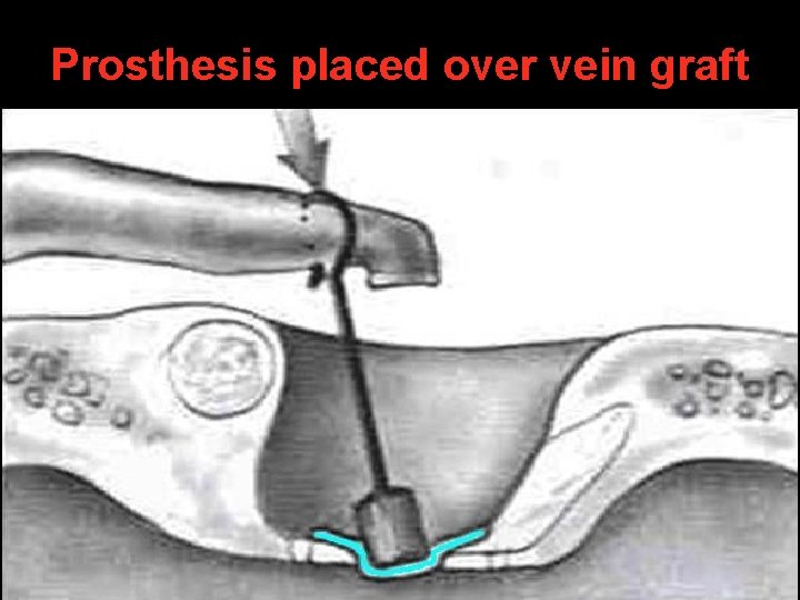 Prosthesis placed over vein graft Prosthesis placed over vein graft
