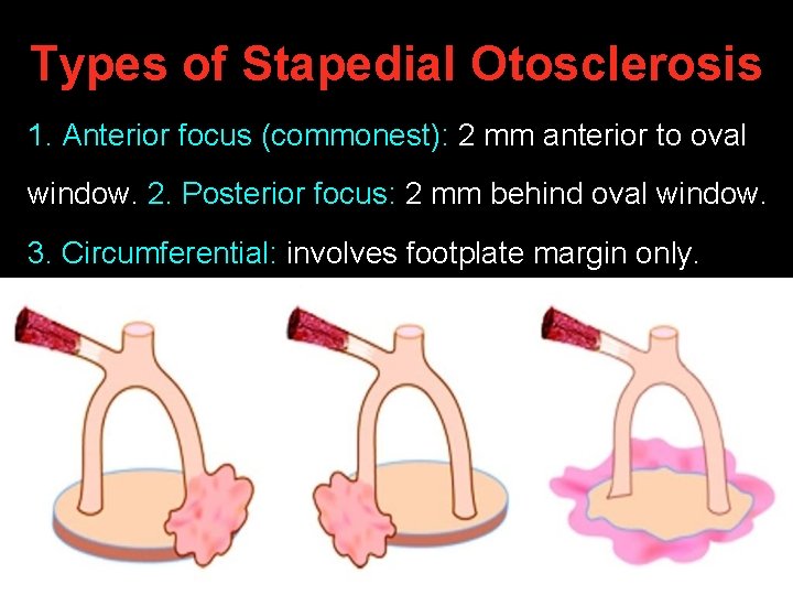 Types of Stapedial Otosclerosis 1. Anterior focus (commonest): 2 mm anterior to oval window. Types of Stapedial Otosclerosis 1. Anterior focus (commonest): 2 mm anterior to oval window.