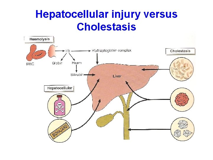 Hepatocellular injury versus Cholestasis 
