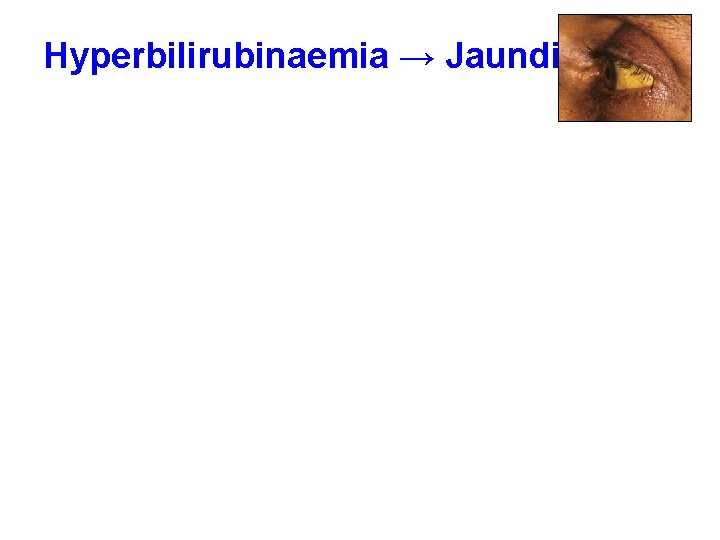Hyperbilirubinaemia → Jaundice 