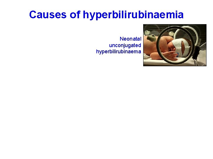 Causes of hyperbilirubinaemia Neonatal unconjugated hyperbilirubinaema 
