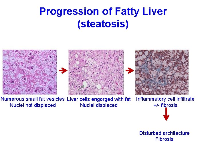 Progression of Fatty Liver (steatosis) Numerous small fat vesicles Liver cells engorged with fat