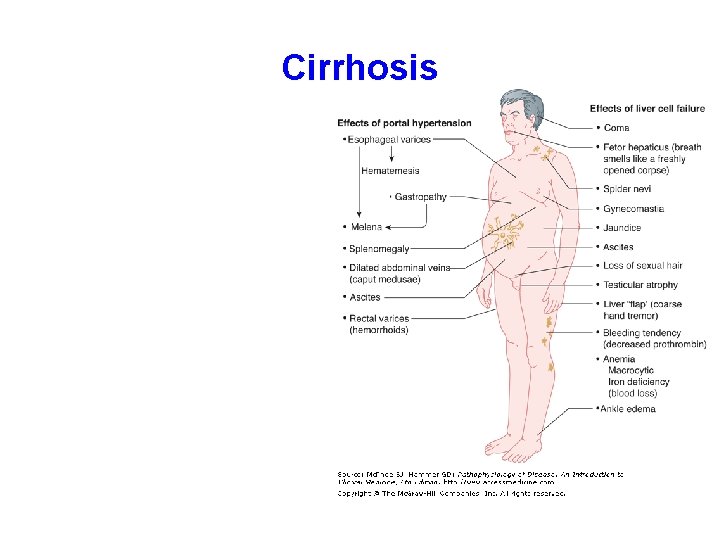 Cirrhosis 