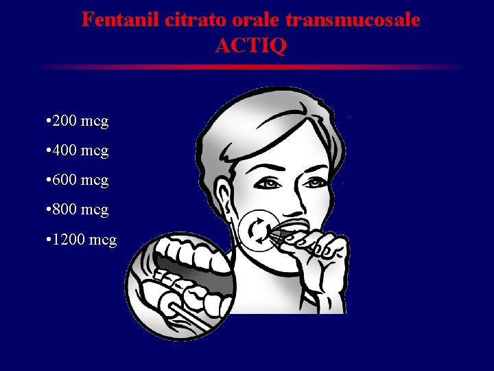Fentanil citrato orale transmucosale ACTIQ • 200 mcg • 400 mcg • 600 mcg Fentanil citrato orale transmucosale ACTIQ • 200 mcg • 400 mcg • 600 mcg