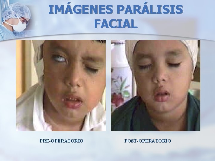 IMÁGENES PARÁLISIS FACIAL PRE-OPERATORIO POST-OPERATORIO 