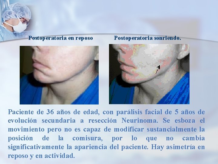 Postoperatoria en reposo Postoperatoria sonriendo. Paciente de 36 años de edad, con parálisis facial