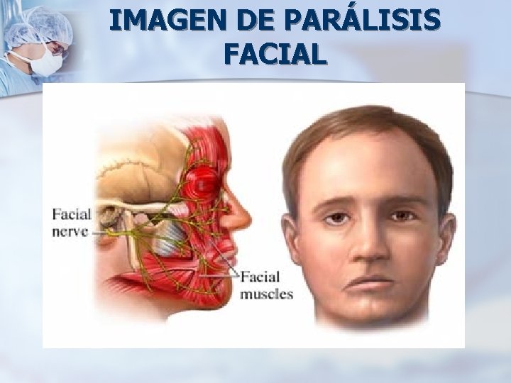 IMAGEN DE PARÁLISIS FACIAL 