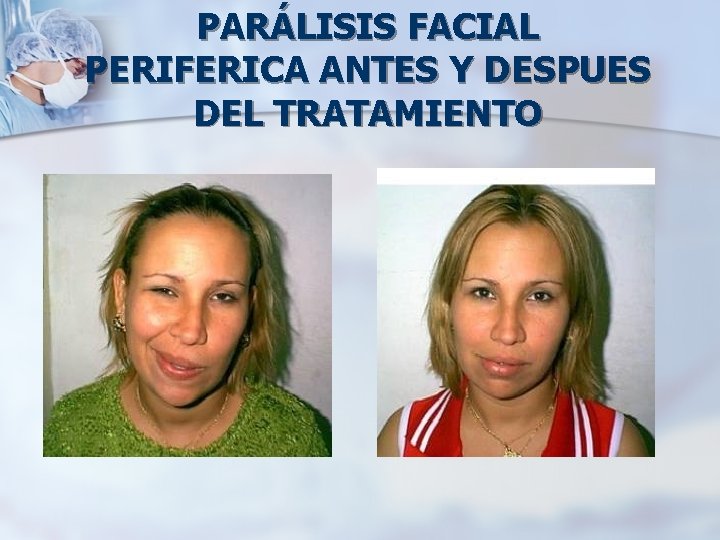 PARÁLISIS FACIAL PERIFERICA ANTES Y DESPUES DEL TRATAMIENTO 