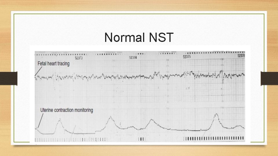 Normal NST 