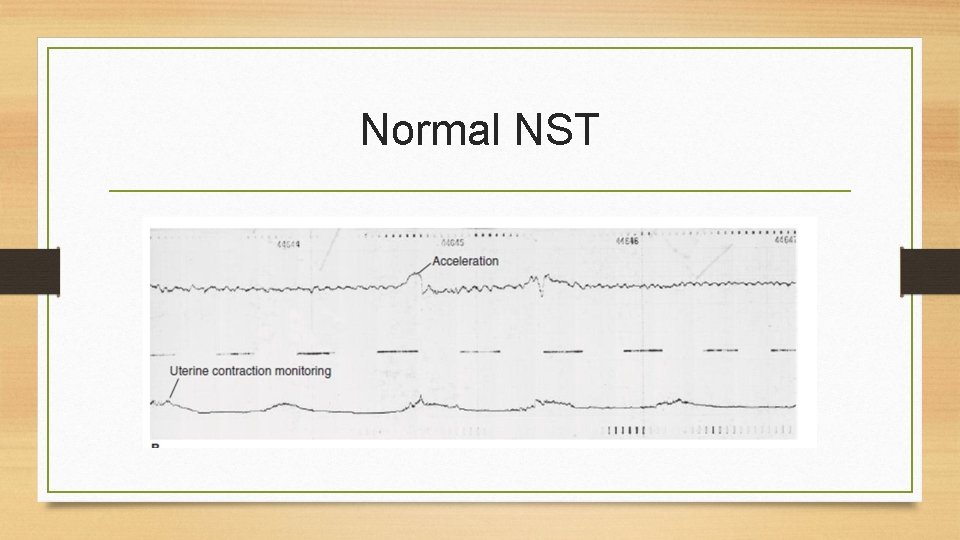 Normal NST 