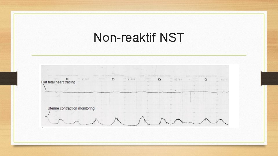 Non-reaktif NST 