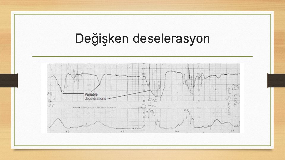 Değişken deselerasyon 