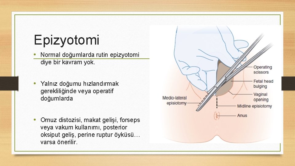 Epizyotomi • Normal doğumlarda rutin epizyotomi diye bir kavram yok. • Yalnız doğumu hızlandırmak