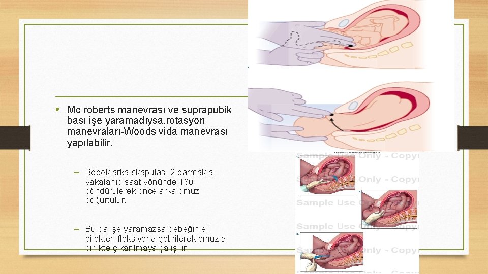  • Mc roberts manevrası ve suprapubik bası işe yaramadıysa, rotasyon manevraları-Woods vida manevrası