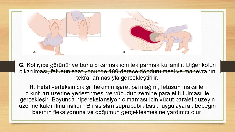 G. Kol iyice görünür ve bunu cıkarmak icin tek parmak kullanılır. Diğer kolun cıkarılması,