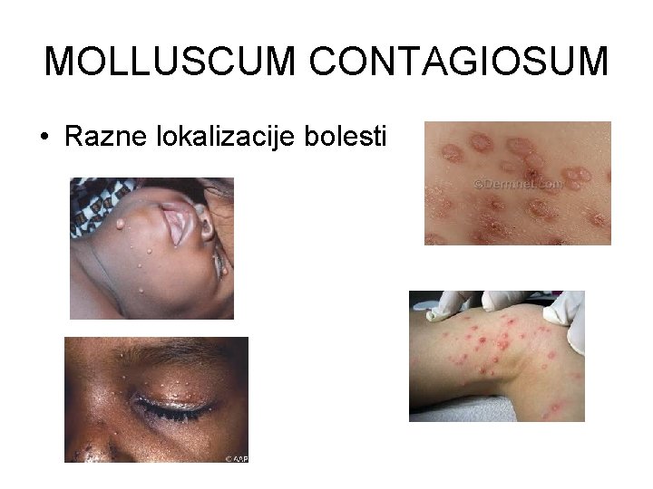 MOLLUSCUM CONTAGIOSUM • Razne lokalizacije bolesti 