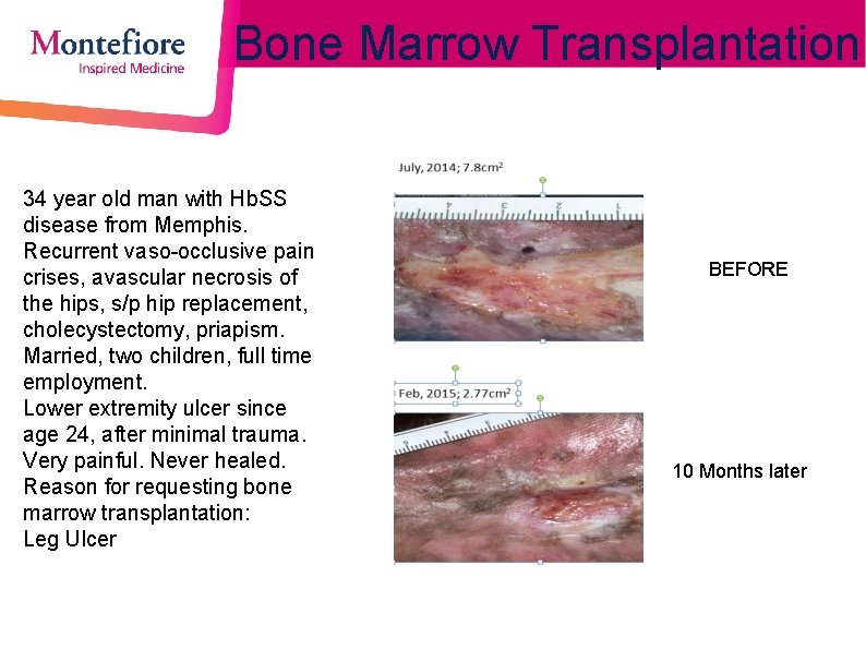 Bone Marrow Transplantation 34 year old man with Hb. SS disease from Memphis. Recurrent