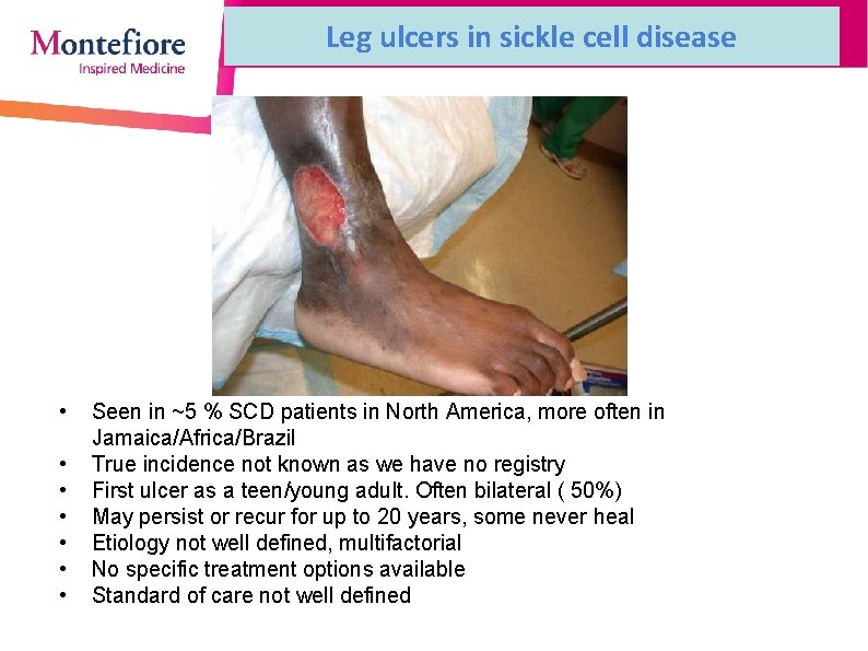 Leg ulcers in sickle cell disease • • Seen in ~5 % SCD patients