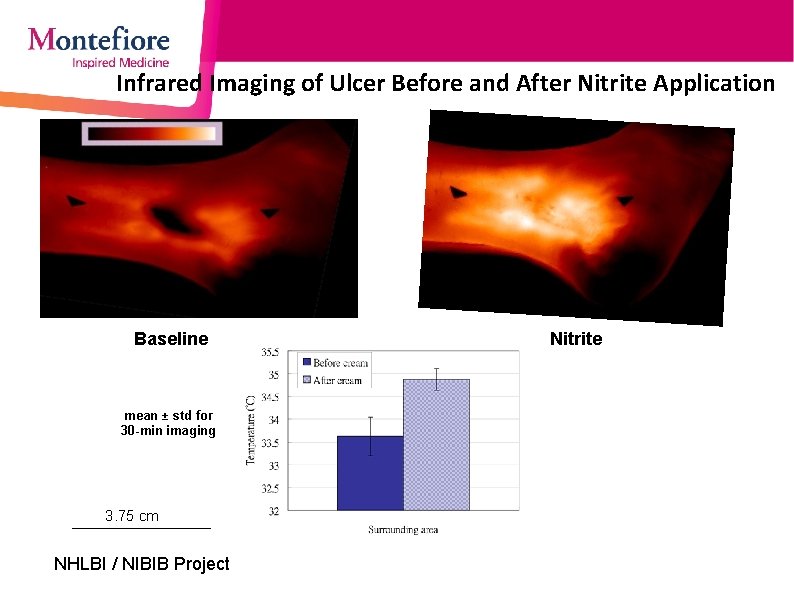 Infrared Imaging of Ulcer Before and After Nitrite Application Baseline mean ± std for