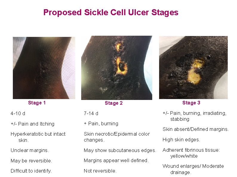 Proposed Sickle Cell Ulcer Stages Stage 1 Stage 2 4 -10 d 7 -14