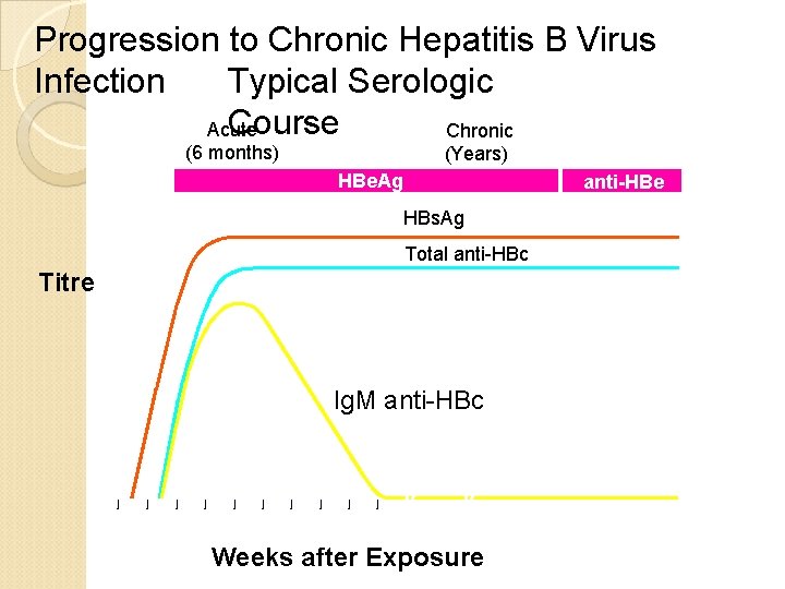 Progression to Chronic Hepatitis B Virus Typical Serologic Infection Course Acute Chronic (6 months)