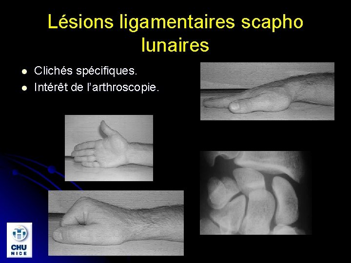 Lésions ligamentaires scapho lunaires l l Clichés spécifiques. Intérêt de l’arthroscopie. 