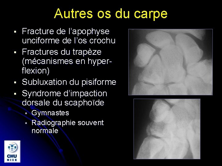 Autres os du carpe § § Fracture de l’apophyse unciforme de l’os crochu Fractures