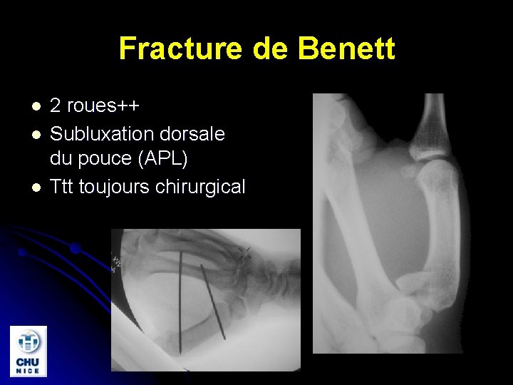 Fracture de Benett l l l 2 roues++ Subluxation dorsale du pouce (APL) Ttt