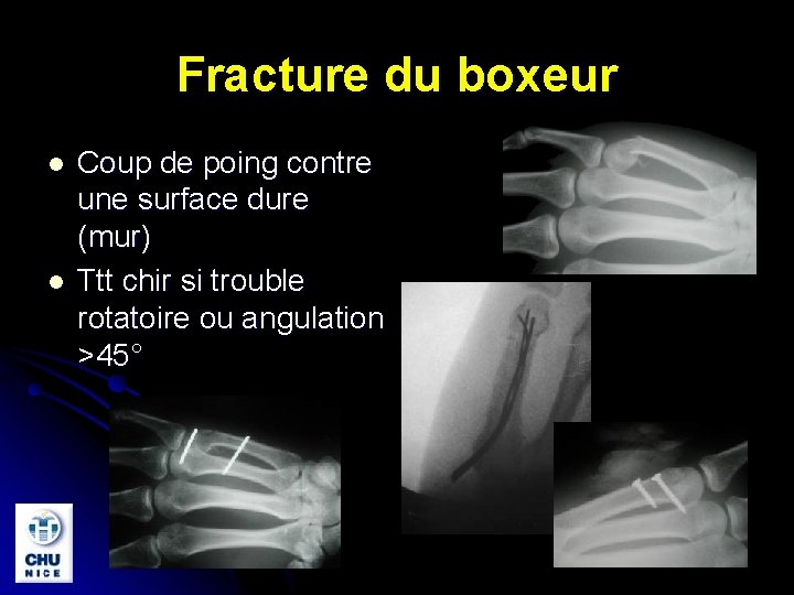 Fracture du boxeur l l Coup de poing contre une surface dure (mur) Ttt