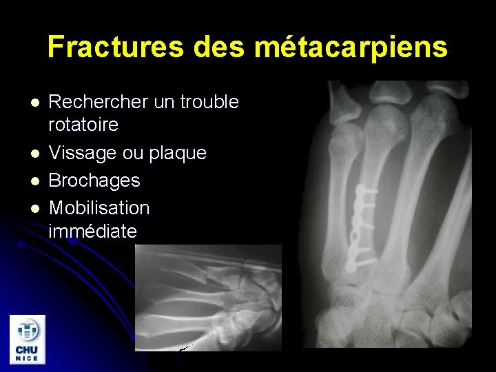 Fractures des métacarpiens l l Recher un trouble rotatoire Vissage ou plaque Brochages Mobilisation