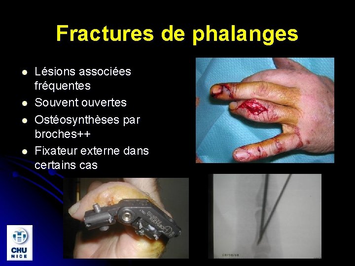 Fractures de phalanges l l Lésions associées fréquentes Souvent ouvertes Ostéosynthèses par broches++ Fixateur