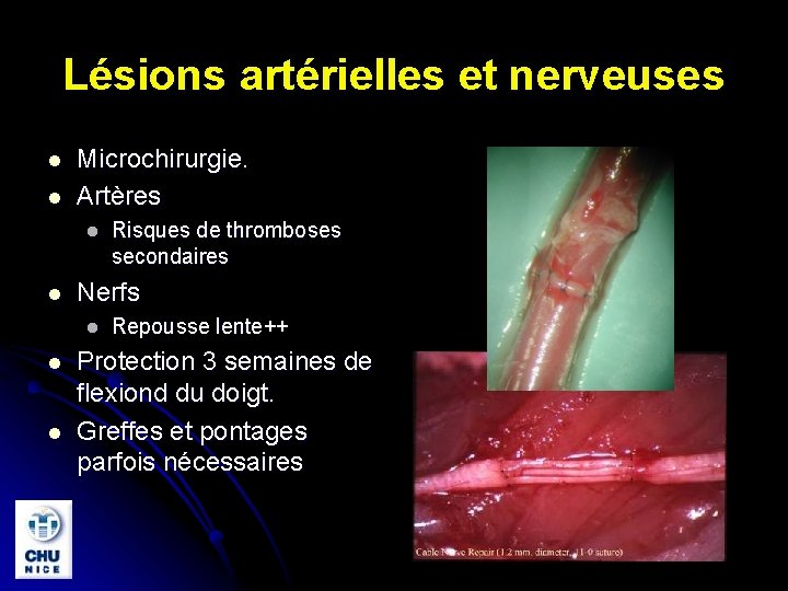Lésions artérielles et nerveuses l l Microchirurgie. Artères l l Nerfs l l l