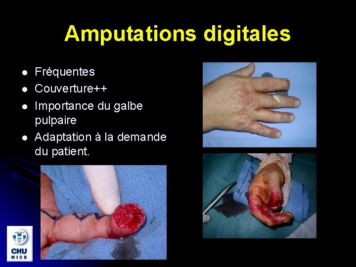 Amputations digitales l l Fréquentes Couverture++ Importance du galbe pulpaire Adaptation à la demande