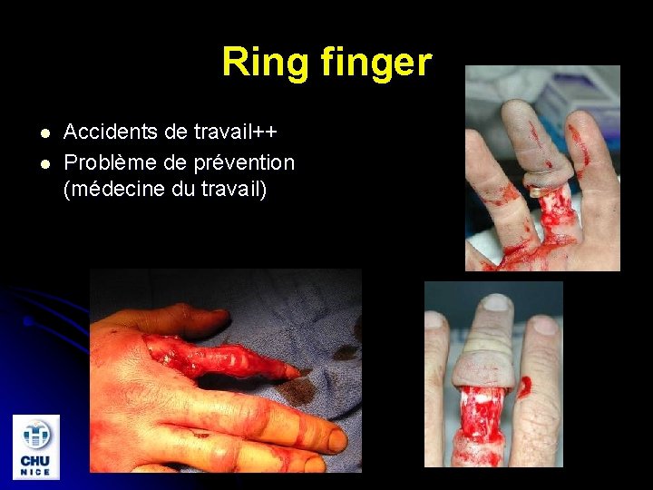 Ring finger l l Accidents de travail++ Problème de prévention (médecine du travail) 